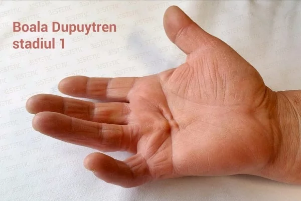 Boala Dupuytren