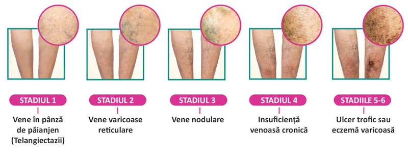 Boala venoasă cronică
